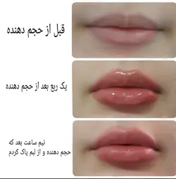 بوتاکس لب